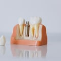 Why Are Tooth Implants Becoming The Preferred Choice For Dental Restoration In Sydney?
