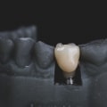 Can I Get a Dental Implant After Tooth Extraction?