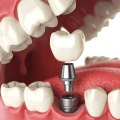 Are Dental Implants Safe? What Are the Contraindications?