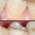 How Many Implants Do You Need for a Full Mouth Restoration?