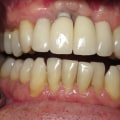 When is Dental Implant Not Possible?