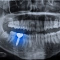 Do Dental Implants Require Regular X-Rays After Placement?
