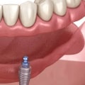 Say Goodbye To Missing Teeth: How Dental Implants Can Transform Your Smile In Cedar Park, TX