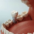 How Teeth Implants Can Influence Chewing Efficiency Beyond Tooth Replacement