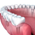 What Materials are Tooth Implants Made Of?
