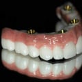 How Many Implants Do You Need for a Full Set of Teeth?