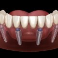 Can Heart Patients Get Dental Implants Safely?