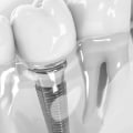 Transform Your Smile With The Best Dentist In Aurora South And Exceptional Teeth Implants