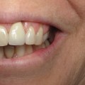 The Road To A Perfect Smile: All About Teeth Implants In Austin, TX
