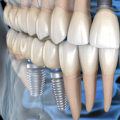 Can You Get Implants with Jaw Bone Loss?