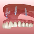 Do Dental Implants Need Regular Adjustments After Placement?