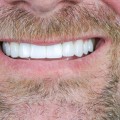 The Benefits Of Teeth Implants In Dripping Springs, TX: Beyond Aesthetics