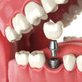 Can I Get a Full Set of Teeth with a Single Implant?