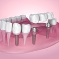 Are Dental Implants the Right Choice for Everyone?