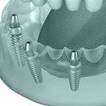The Role Of A Children's Emergency Dentist In Basel For Young Patients Needing Teeth Implants