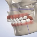 Can I Get a Dental Implant After Jaw Surgery or Trauma?