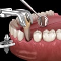 Should You Get an Implant After Tooth Extraction?