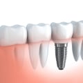Do Dental Implants Require Regular Check-Ups After Placement?
