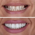 How Teeth Implants Support Natural-Looking Smiles