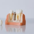 Transforming Smiles In San Antonio, TX: The Power Of Teeth Implants