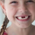 Helping Your Child Smile Again: Teeth Implants For Kids In Summerville, SC