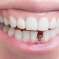 Can Anyone Get Teeth Implants?