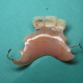 No Teeth While Waiting for Implants? Here's What You Can Do