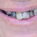 Regain Your Smile With Teeth Implants In Taylor, TX