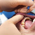 Are Dental Implants Safe for Your Heart?