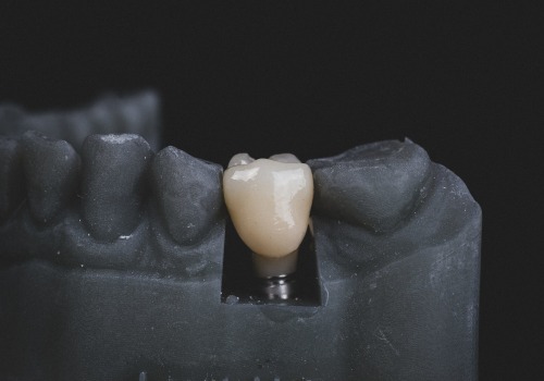 Can I Get a Dental Implant After Tooth Extraction?
