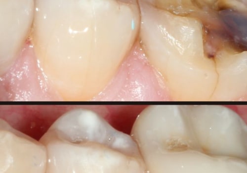 How Many Implants Do You Need for a Full Mouth Restoration?
