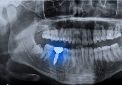 Do Dental Implants Require Regular X-Rays After Placement?