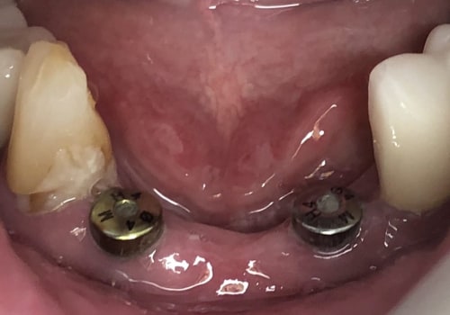 Can I Get a Dental Implant After a Tooth Extraction?