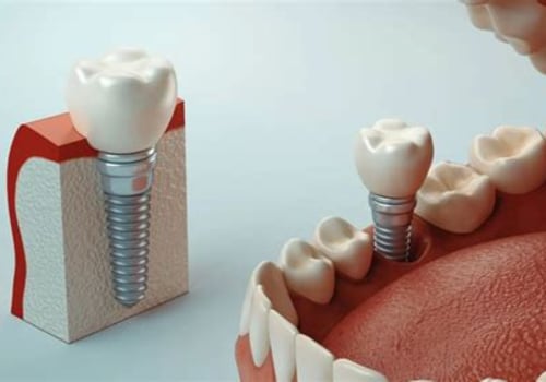 How Teeth Implants Can Influence Chewing Efficiency Beyond Tooth Replacement