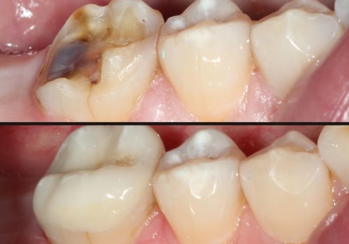 Should You Save a Tooth or Get an Implant?