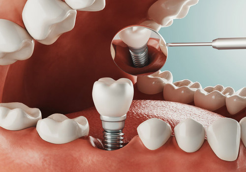 Alternatives to Teeth Implants: What Are Your Options?