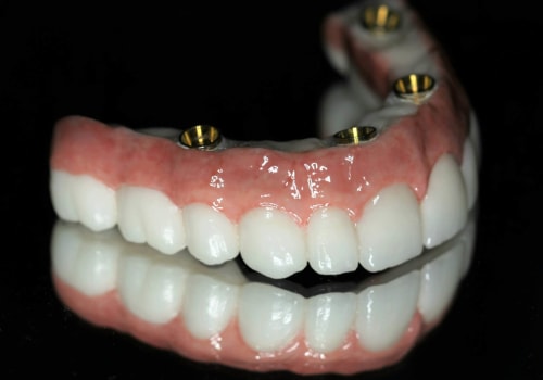 How Many Implants Do You Need for a Full Set of Teeth?