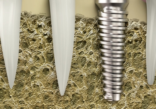 Teeth Implants On Main Street: A Comprehensive Guide To Dental Implant Advancements