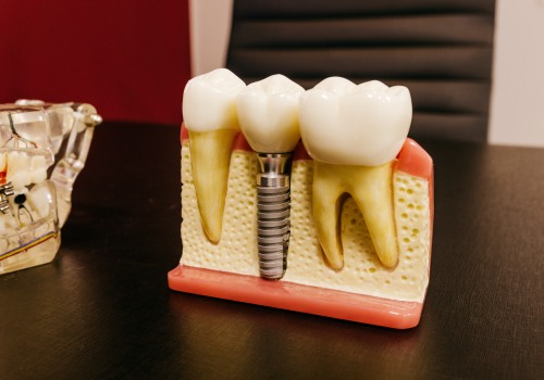 San Antonio's Restorative Dentistry Revolution: How Teeth Implants Are Changing Lives