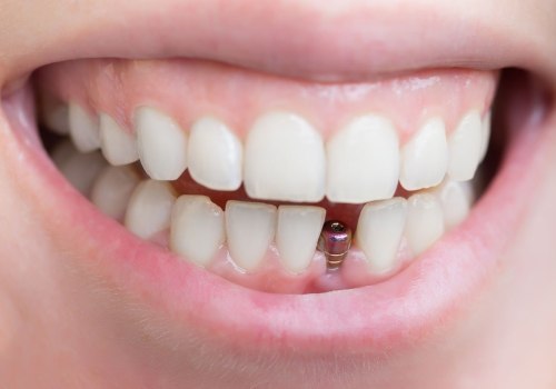 Caring for Dental Implants: What You Need to Know