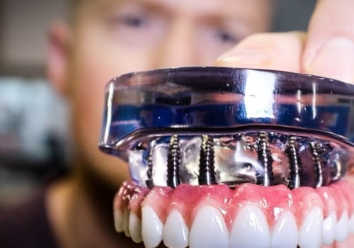 Transform Your Smile With Teeth Implants: Finding The Best Dental Implants Dentist In Pflugerville, TX