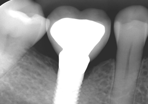 What is the Gap between Implant Crown and Tooth?
