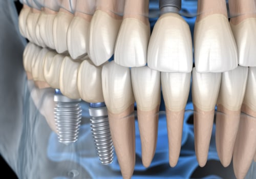 Can You Get Implants with Jaw Bone Loss?