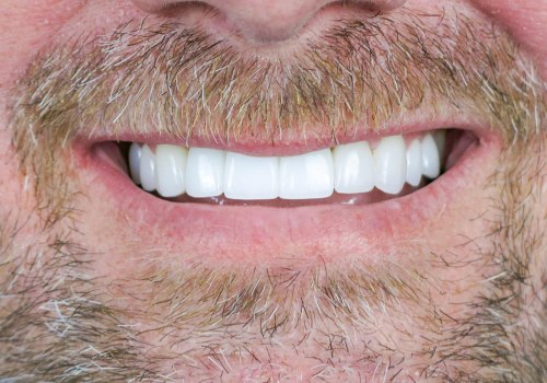 The Benefits Of Teeth Implants In Dripping Springs, TX: Beyond Aesthetics