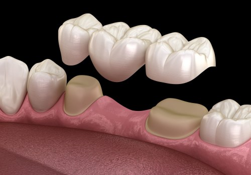 Experience The Transformation: Dental Implants In Spring Branch