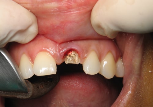 How Long Does it Take to Get Teeth Implants?