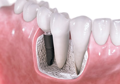Rebuilding And Refining: Invisalign Braces Following Teeth Implants In Georgetown