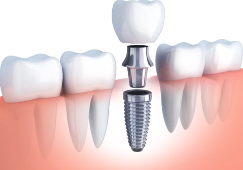 Why are Dental Implants So Unaffordable?