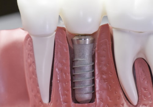 Can I Get a Dental Implant After Root Canal Treatment?