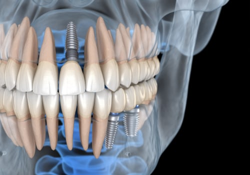Smile Confidently: All About Teeth Implants In Conroe, TX